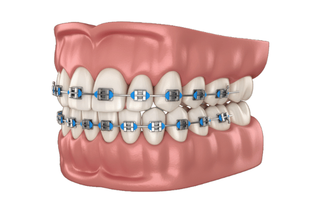 Ortodoncia Ilustración en 3D de dientes humanos con aparatos metálicos y bandas azules en los maxilares superior e inferior, mostrando un tratamiento de ortodoncia en un conjunto de encías.