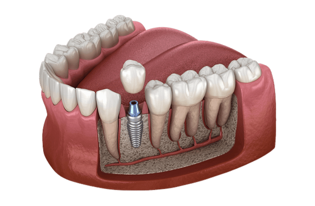 Ilustración en 3D de un maxilar inferior con dientes, encías y estructura ósea visibles. Un diente se sustituye por un implante dental metálico, lo que demuestra cómo los implantes dentales La Laguna se anclan en el hueso maxilar entre los dientes naturales.