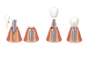 implantes dentales la laguna