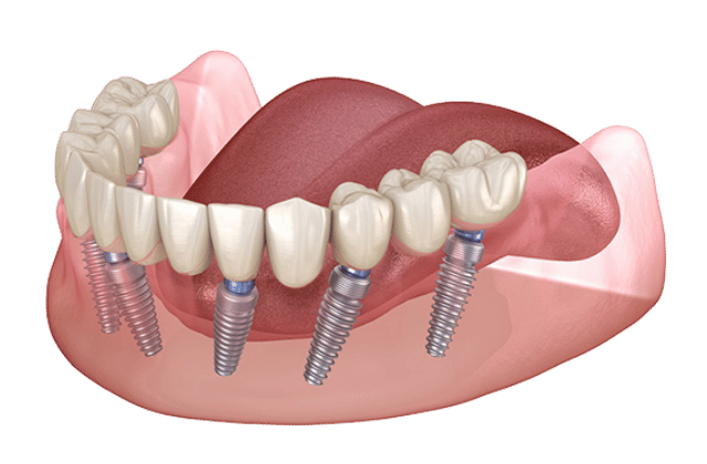 Ilustración en 3D que muestra un maxilar inferior con tejido gingival, dientes y seis implantes dentales La Laguna que soportan un conjunto artificial de dientes inferiores anclados en el hueso maxilar.