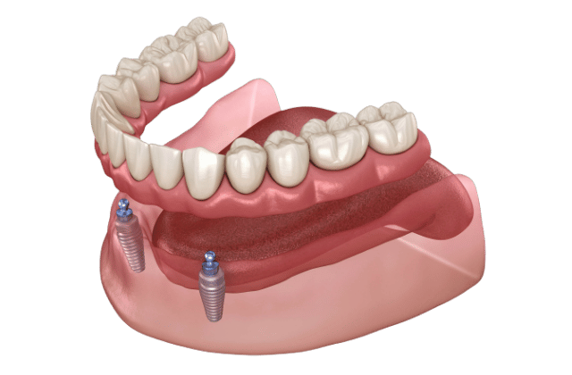 Ilustración digital que muestra una dentadura inferior soportada por dos implantes dentales incrustados en el maxilar inferior en implantes dentales La Laguna, con dientes artificiales fijados a la base del color de la encía.